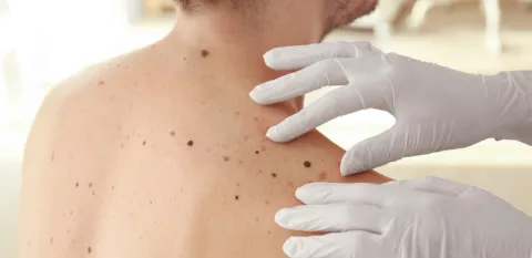 A health care worker's hands with vinyl gloves on are on a man's shoulder where there are various moles of different sizes and colors.